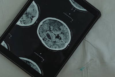 image of brain scan on tablet